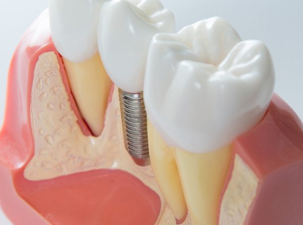 What Factors Affect the Success of Dental Implants?